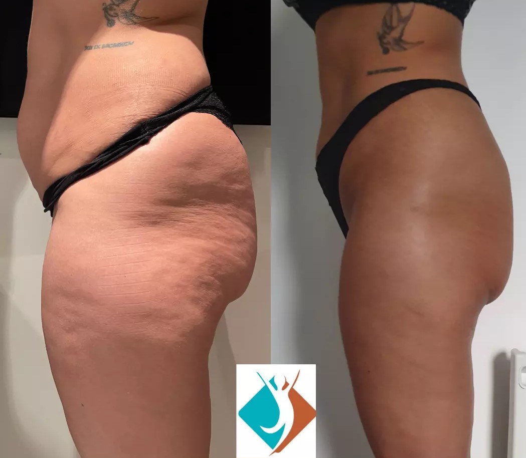 CSM Organic Cellulite Treatment for Slimming, Firming, Tightening, Toning  and Improving Circulation - Natural Cellulitis Treatment for Your Body 