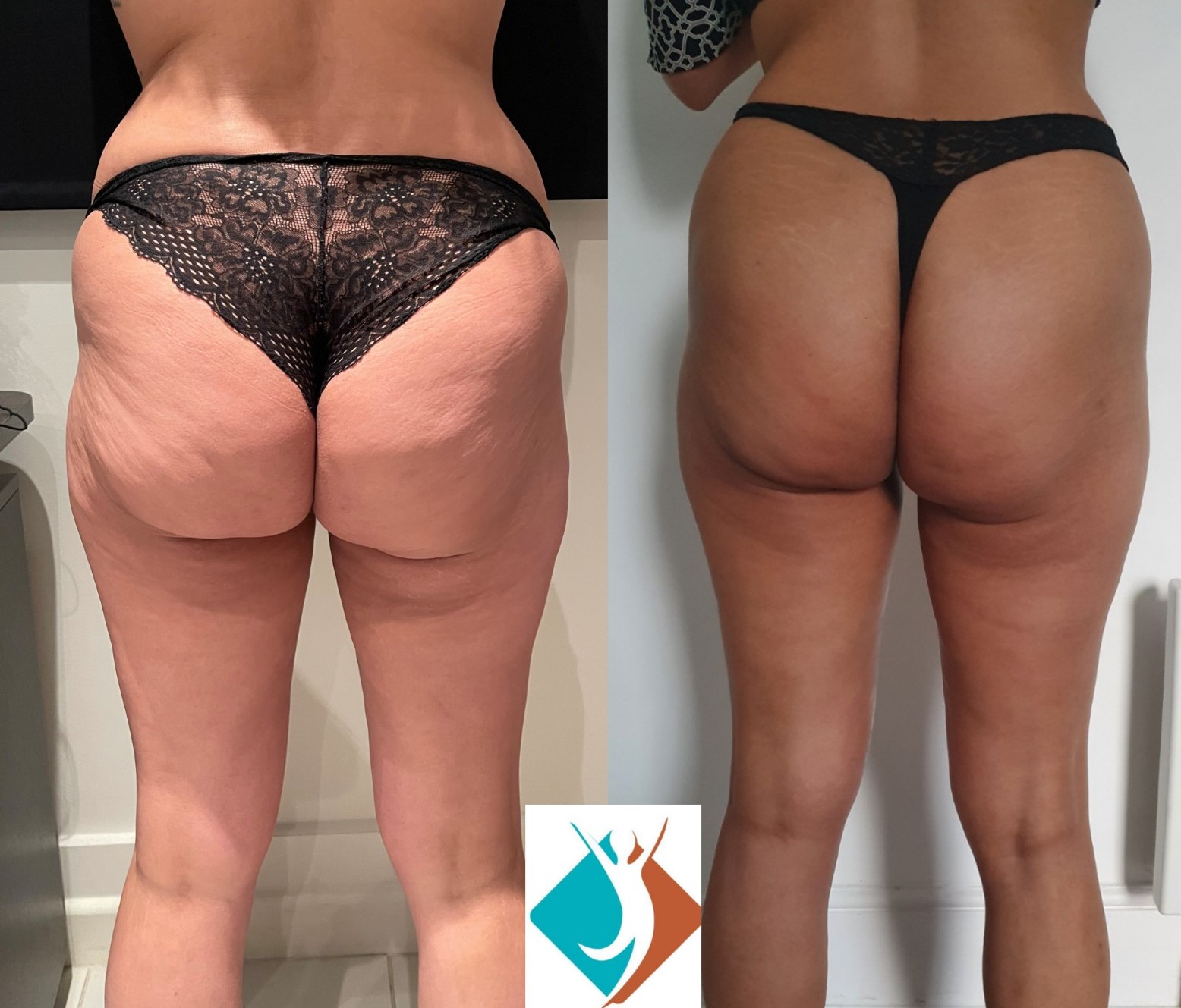 ⚡️Client Results - Cellulite Reduction! ⁠ ⁠ Cellulite can occur due to  various factors, irrespective of your lifestyle, such as a